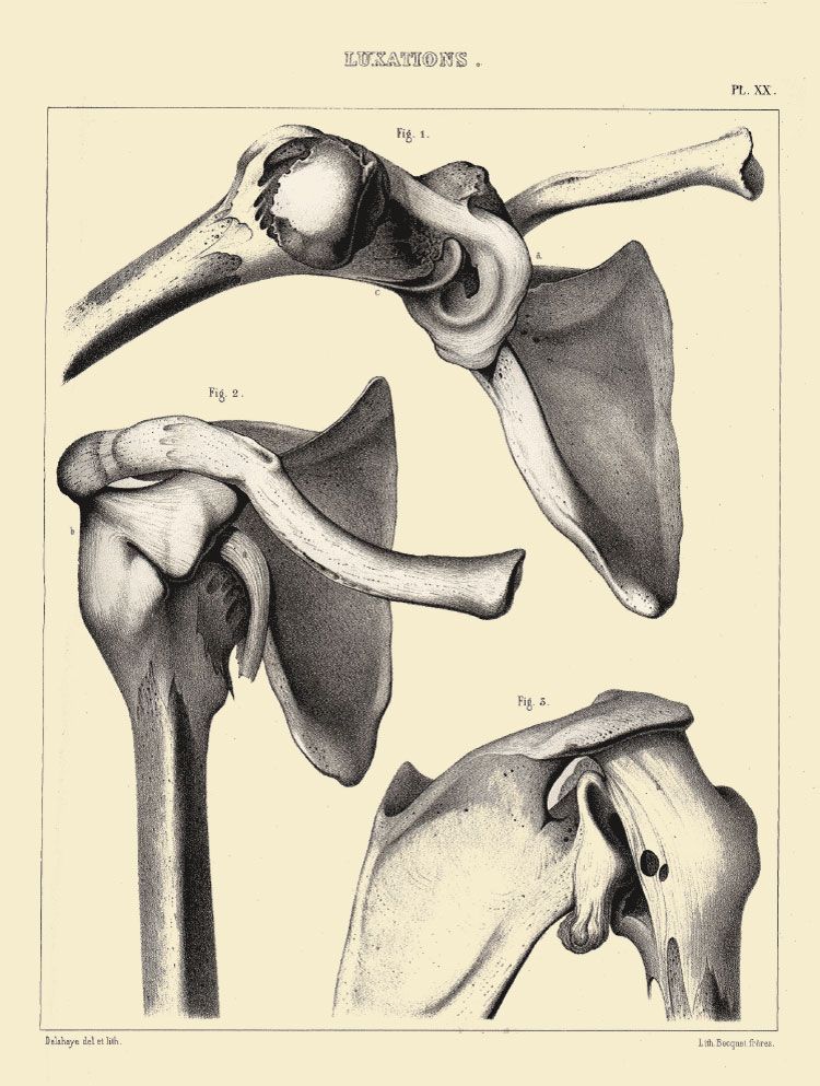 Extrait de l'Atlas du traité des fractures et des luxations. Planche XX XXI XXII : Luxations scapulo-humérales