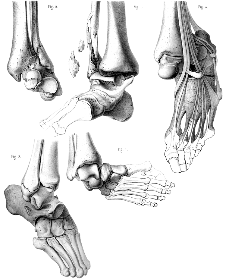 Extrait de l'atlas du traité des fractures et des luxations - Planche XXX : Luxations des os du pied