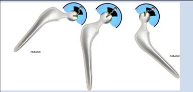 Les prothèses de hanche auxquelles vous avez échappé