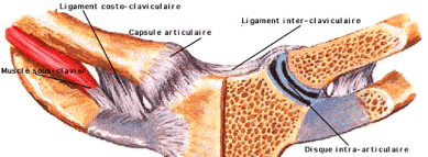 Luxation postérieure sterno-claviculaire