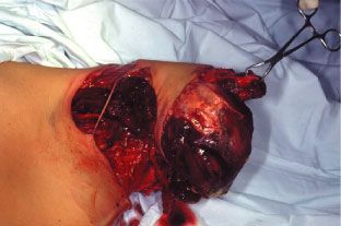 Traumatismes complexes du coude : Stratégie chirurgicale en urgence