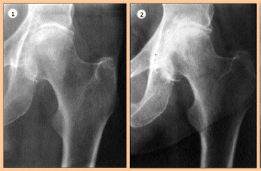 Coxarthrose destructrice rapide