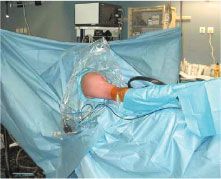 La réparation arthroscopique du Sus-Epineux : est-elle une alternative au traitement chirurgical classique ?