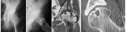 Arthroscopie, butée et forage : un cas de chirurgie conservatrice de la hanche par voies d'abord minimales