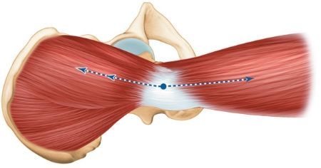 Voie d'abord transglutéale pour prothèse totale de hanche (Hardinge)
