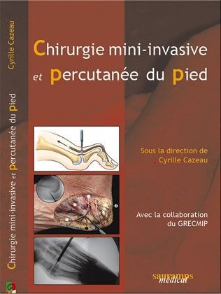 Chirurgie mini-invasive et percutanée du pied