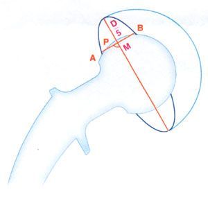 Les luxations précoces des prothèses totales primaires de hanche
