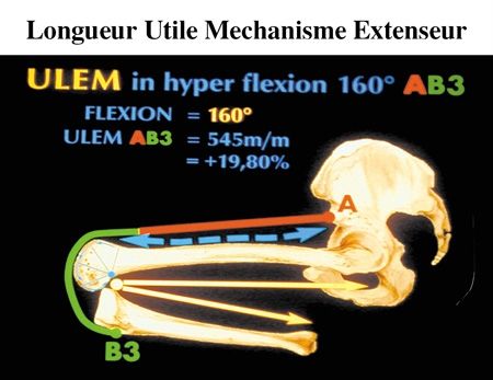 Le concept de grand flexion et le mini-abord dans l'arthroplastie totale du genou