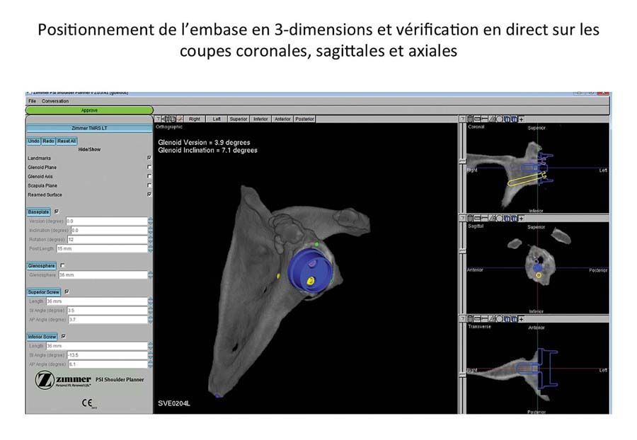 « Patient specific instrumentation »  et prothèse inversée d'épaule