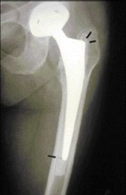 Technique de reconstruction par greffe morcelée impactée et treillis métallique au cours des révisions fémorales d'arthroplastie de hanche