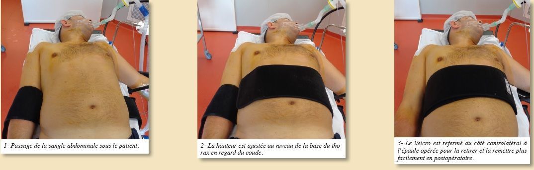 Mise en place au bloc opératoire d’une nouvelle attelle d’immobilisation d’épaule avec ou sans coussin d’abduction