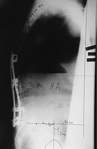 Les ostéotomies de correction des défauts d'alignement sagittal du rachis. Technique de soustraction pédiculaire