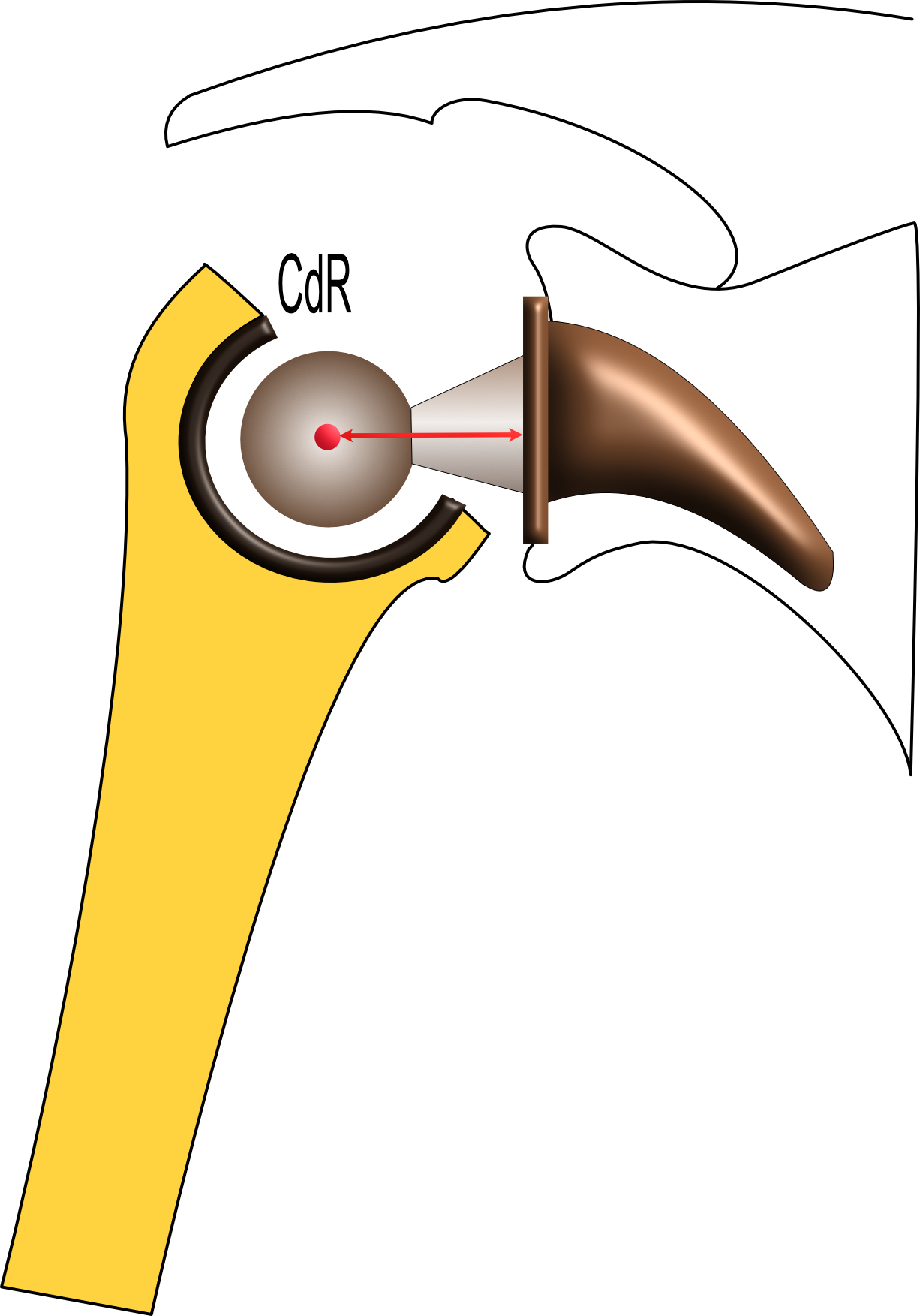 Prothèse inversée d’épaule et latéralisation
