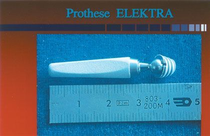 Rapport préliminaire à propos d'une prothèse trapézométacarpienne non cimentée et à cupule vissée