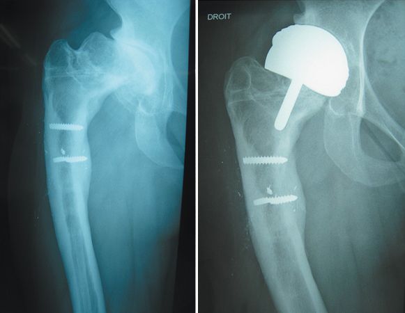 À propos du resurfaçage de hanche : Réflexions et expérience lilloise