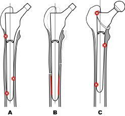 Le concept Press-Fit : principes et application pratique - Reprise d'une prothèse fémorale descellée