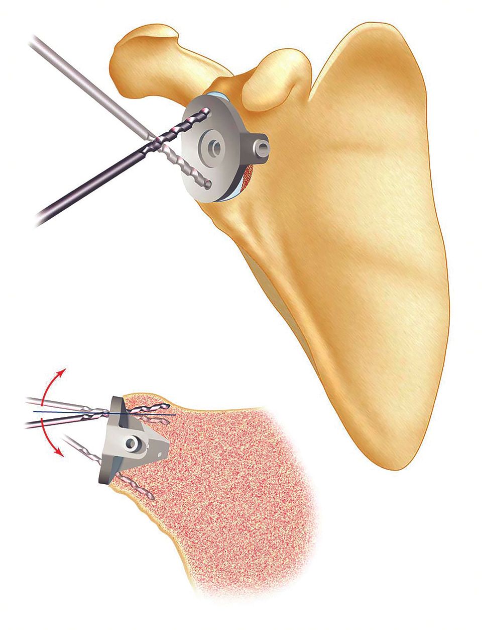 Prothèses d’épaule : les erreurs techniques responsables d’instabilité