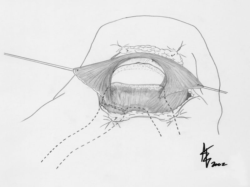 Le transfert du grand dorsal dans les ruptures irréparables de la coiffe des rotateurs