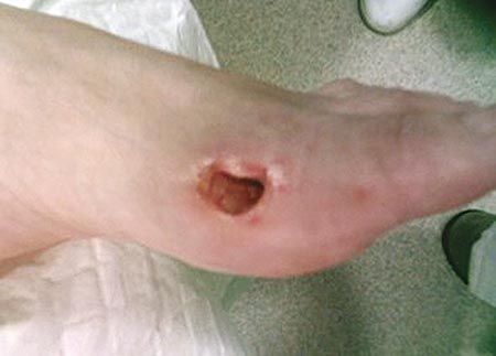 Complications de la chirurgie percutanée de l'avant-pied