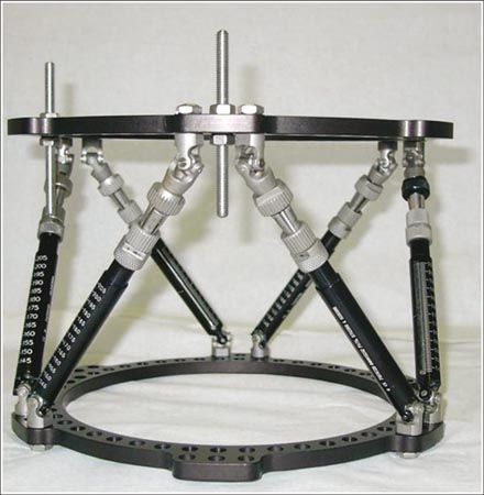 Traitement des fractures du tibia chez l'enfant par fixation externe hexapodale