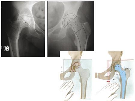 Planification informatique d'une prothèse totale de hanche - Intérêts dans l'utilisation d'une prothèse à col modulaire