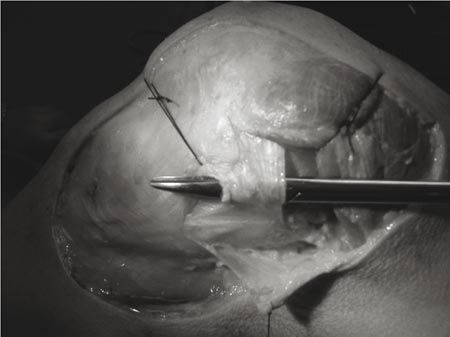 Prothèse de genou par voie subvastus - installation et exposition