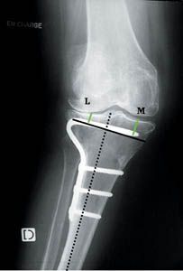Prothèse totale de genou et ostéotomie tibiale associée
