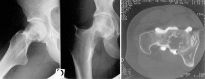 Démarche diagnostique devant une image osseuse d'allure tumorale