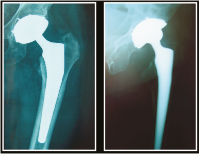 Mini-incision transglutéale dans l’arthroplastie totale de hanche :  à propos de 140 cas