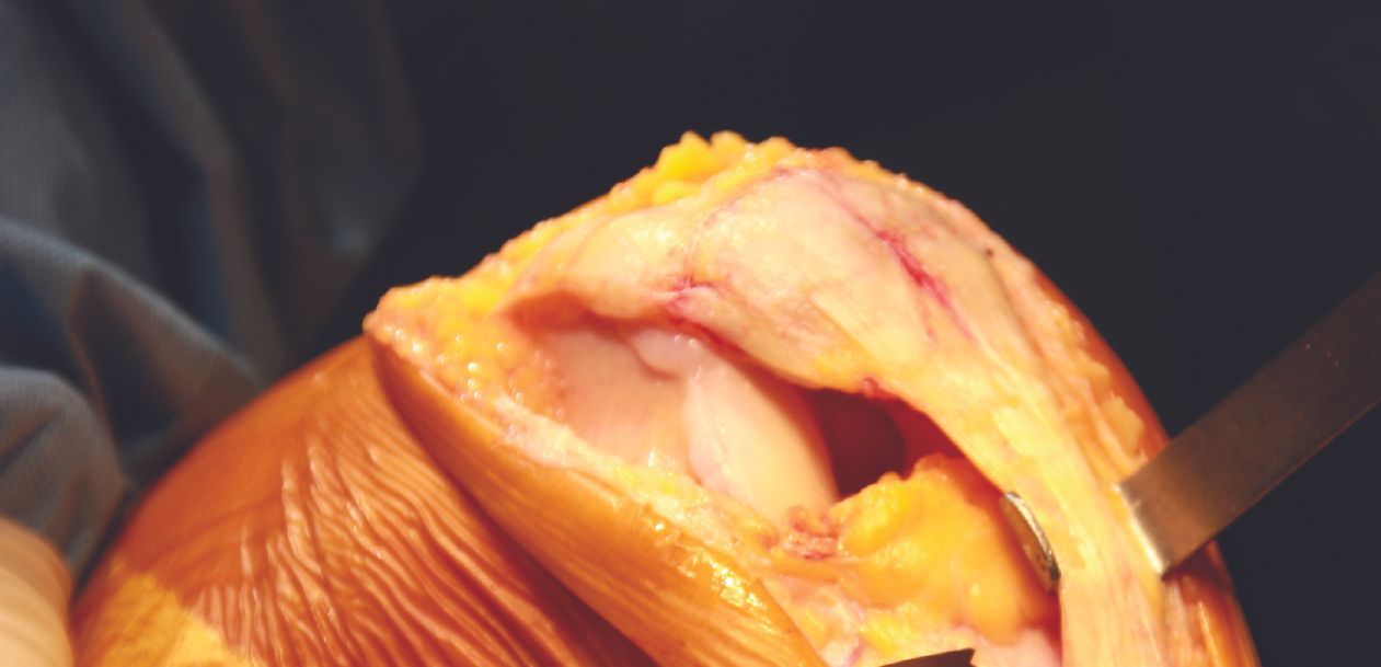 Pourquoi utiliser une voie d’abord latérale dans la prothèse fémoro-patellaire ?