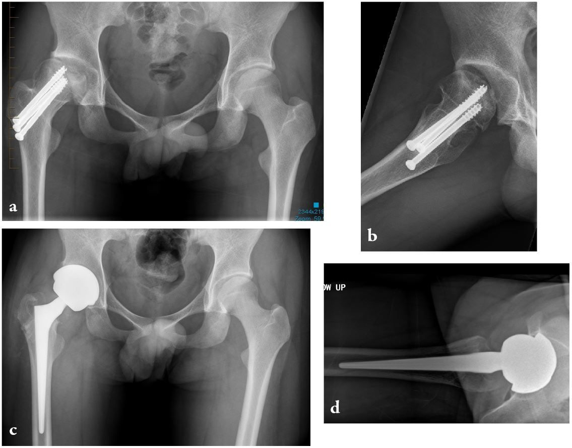 Remplacement personnalisé de l’articulation de la hanche avec une tête de grand diamètre