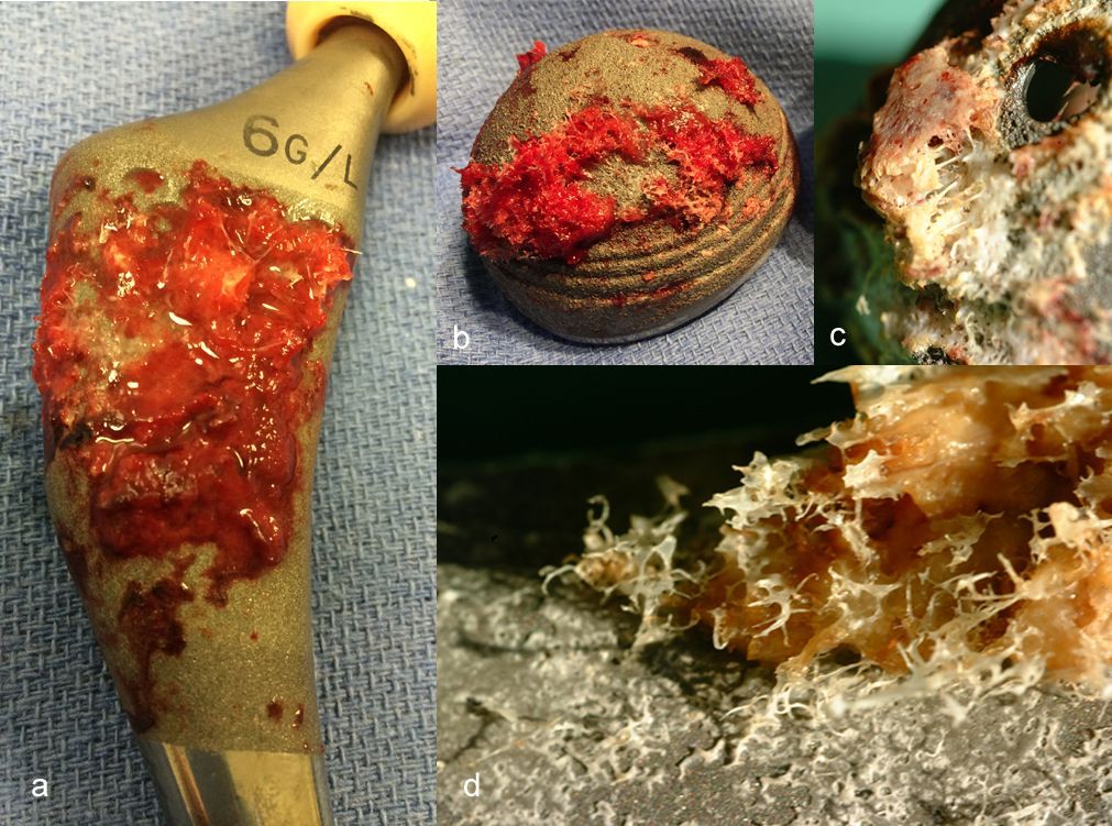 Hydroxyapatite et Prothèses de Hanche : Quel bilan à 34 ans d’expérience clinique ?