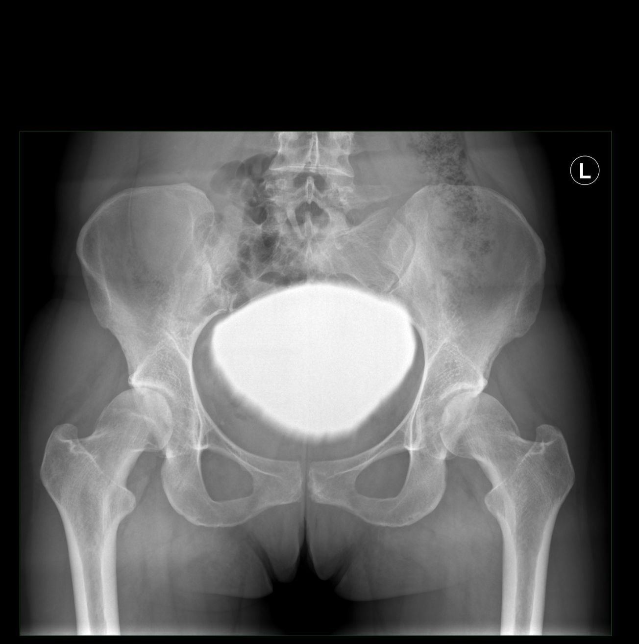 Ostéotomie périacétabulaire et traitement assisté sous arthroscopie simultanés de l'atteinte de type came et de la dysplasie acétabulaire