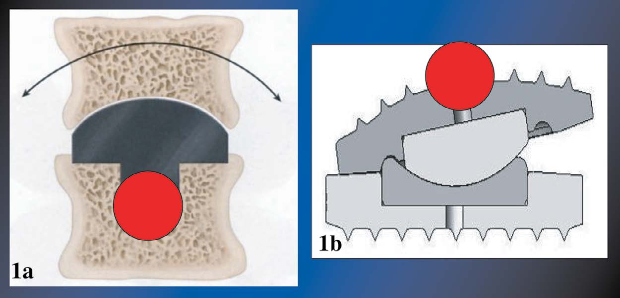 Les prothèses discales cervicales