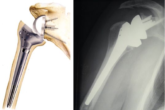 Comment limiter l’encoche scapulaire des prothèses inversées :  latéralisation, infériorisation, inclinaison ?