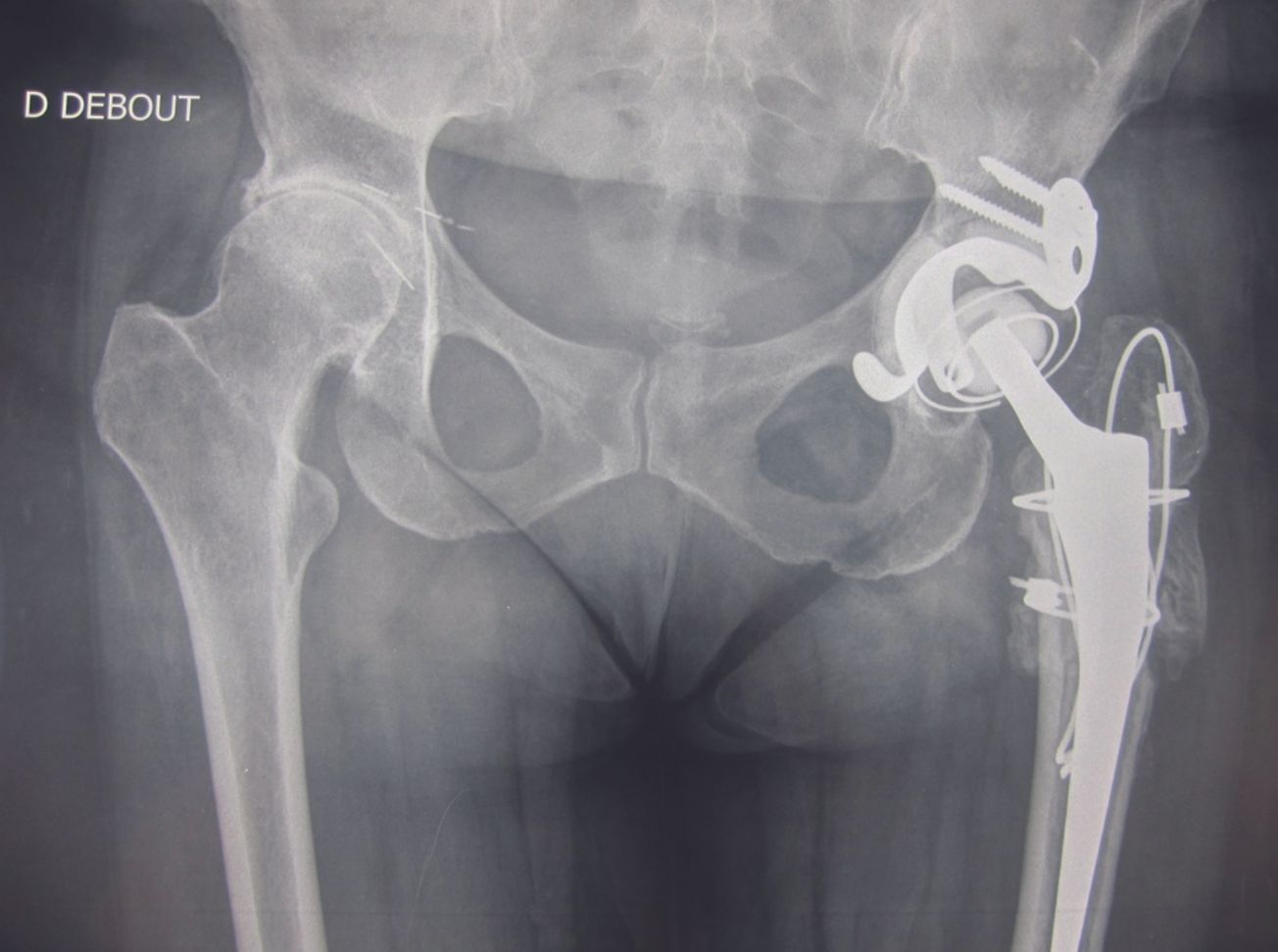 Reconstruction du cotyle dans les reprises de PTH par Double Cupule et Ingénierie Tissulaire Osseuse