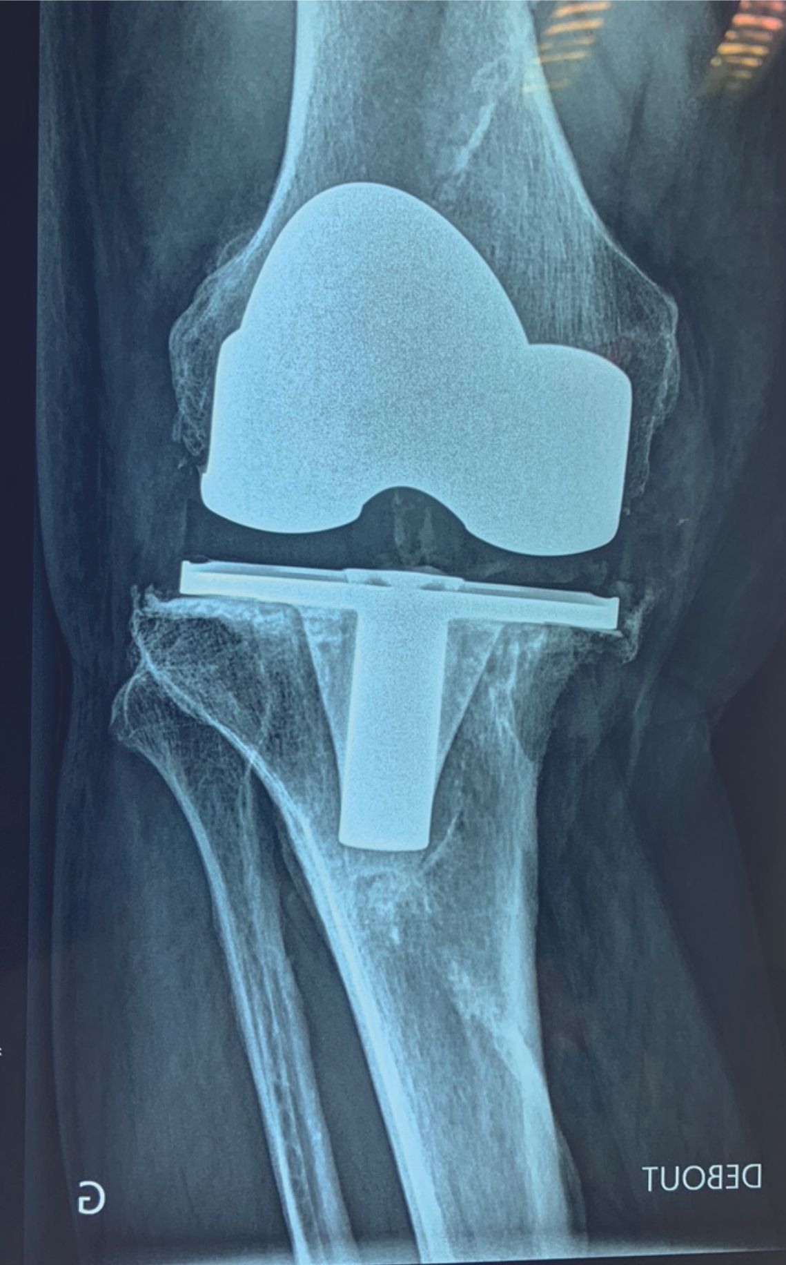 Les facteurs de raideur après PTG