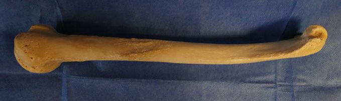 Abord postérieur du nerf radial