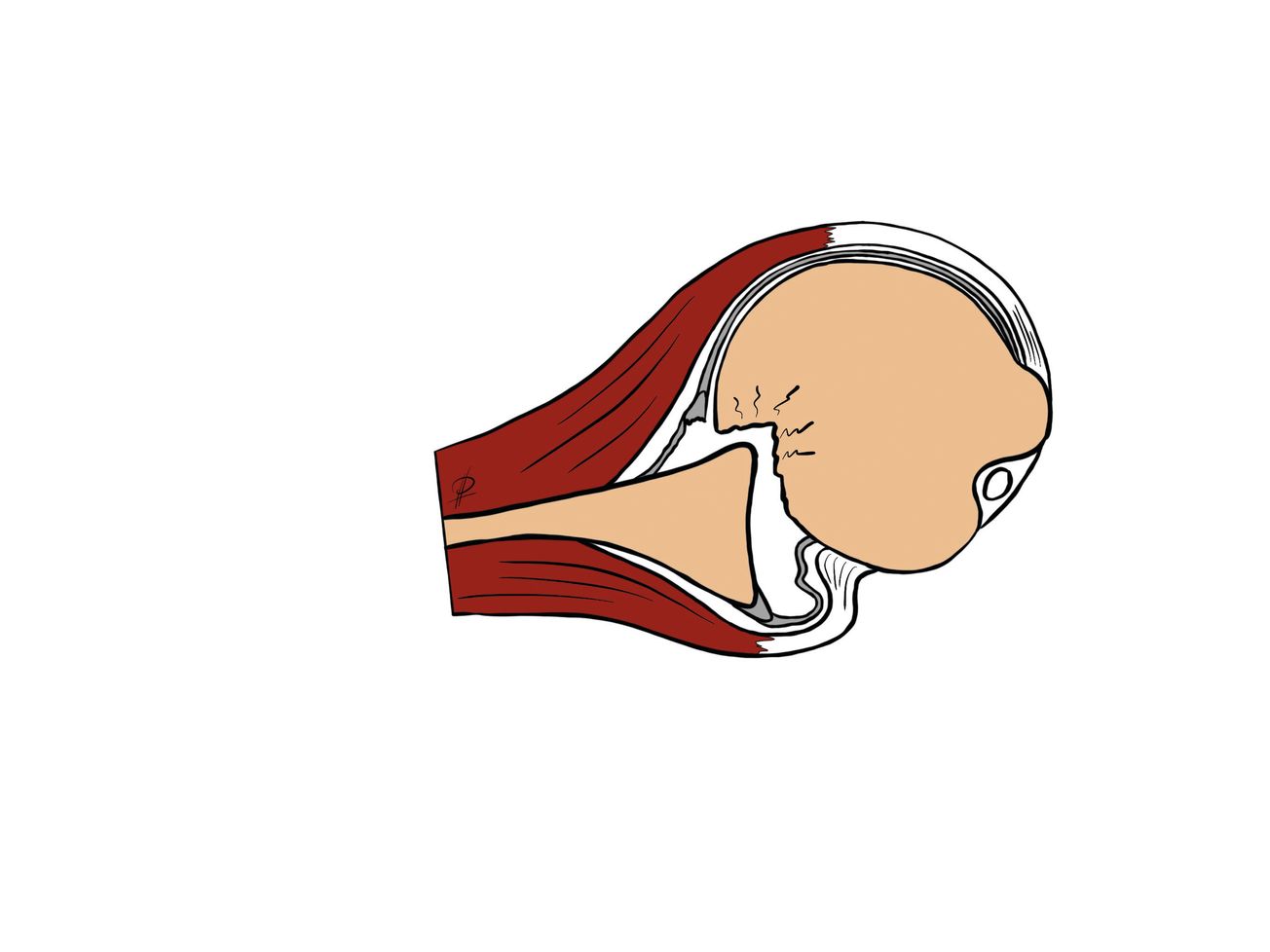 Remplissage  quand le Bankart ne suffit pas !