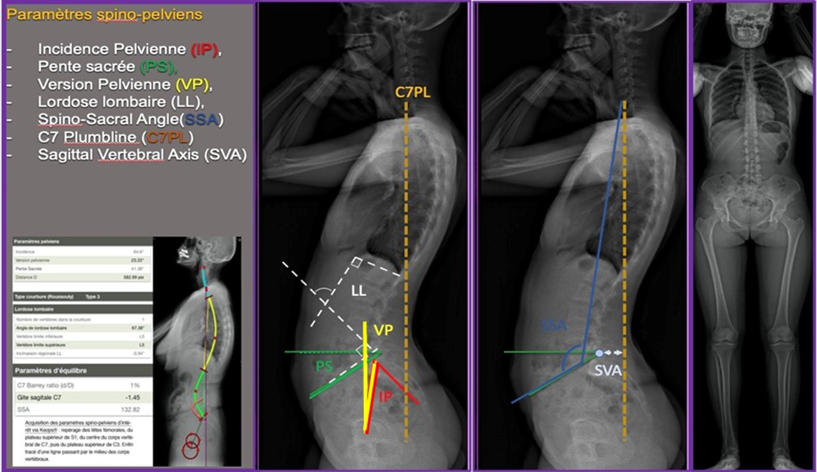 « Hip spine syndrom » implication du complexe lombopelvien et de la hanche orientation diagnostique