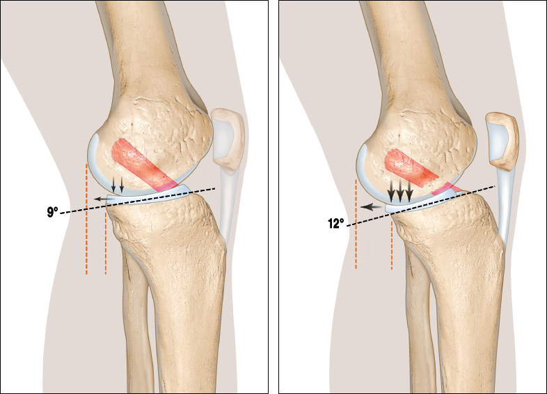 Le rôle de la pente tibiale dans la rerupture du LCA : quand et comment la corriger ?