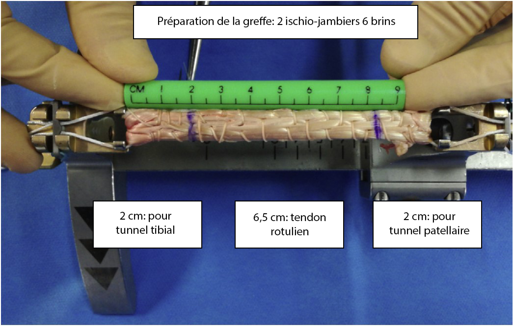 Rupture chronique du tendon rotulien sur genou natif : reconstruction par autogreffe tendineuse aux ischio-jambiers