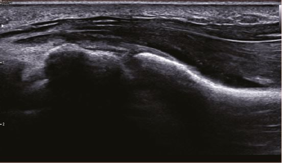 L’échographie pour le chirurgien du membre supérieur