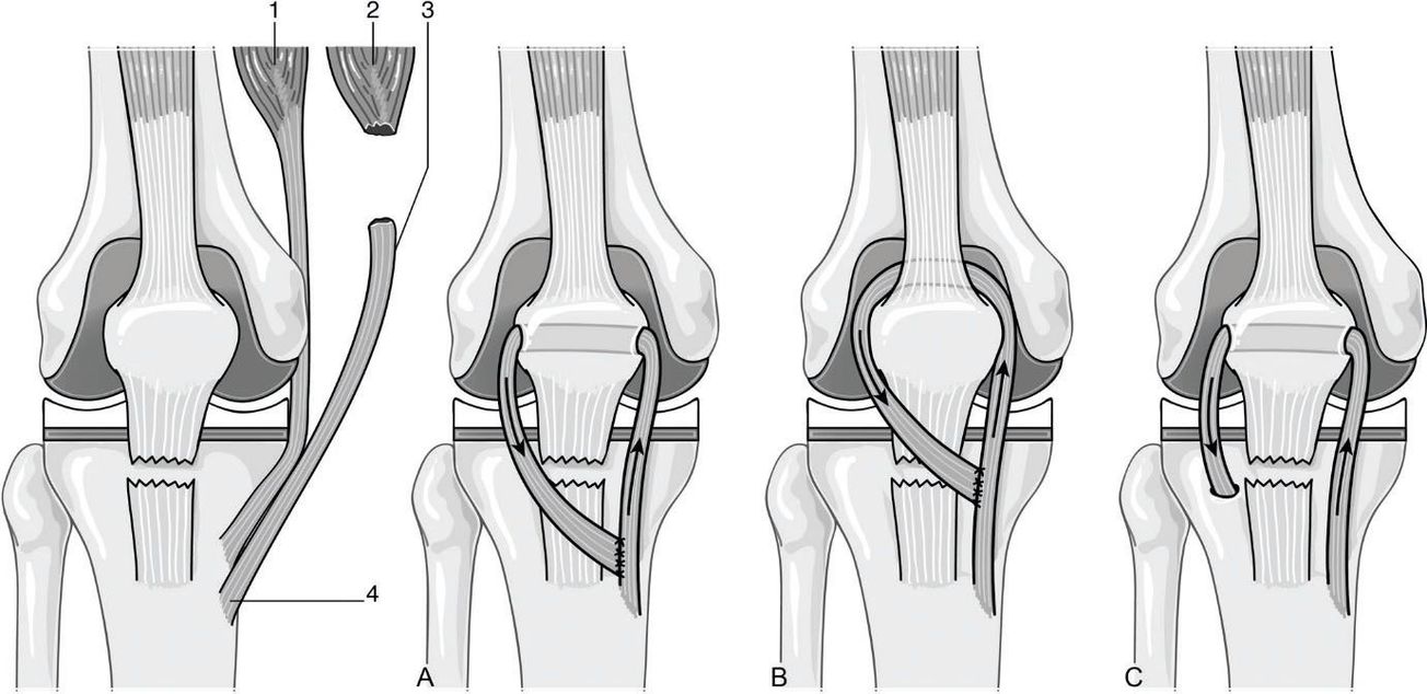Prise en charge chirurgicale de la rupture de l’appareil extenseur avec une PTG