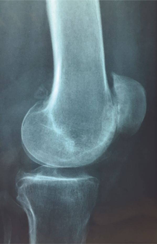 Le positionnement des pièces prothétiques dans la prothèse fémoro-patellaire : Les 10 commandements