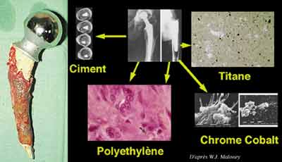 Faut-il cimenter les tiges standards des PTH ? Les tiges, cimentées et non cimentées, doivent-elles être courbes dans le plan sagittal ?