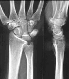 Quelques nouveautés dans la chirurgie du poignet