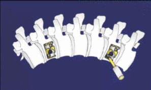 Traitement chirurgical par instrumentation antérieure des scolioses lombaires et thoraco-lombaires