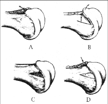 Condyloplastie externe du fémur pour instabilité fémoro-patellaire