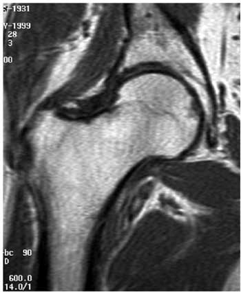 Place de l'imagerie dans le diagnostic de l'ostéonécrose idiopathique de la tête fémorale